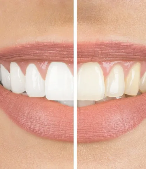/img/32028-teeth-whitening-marbella-maintenance.webp