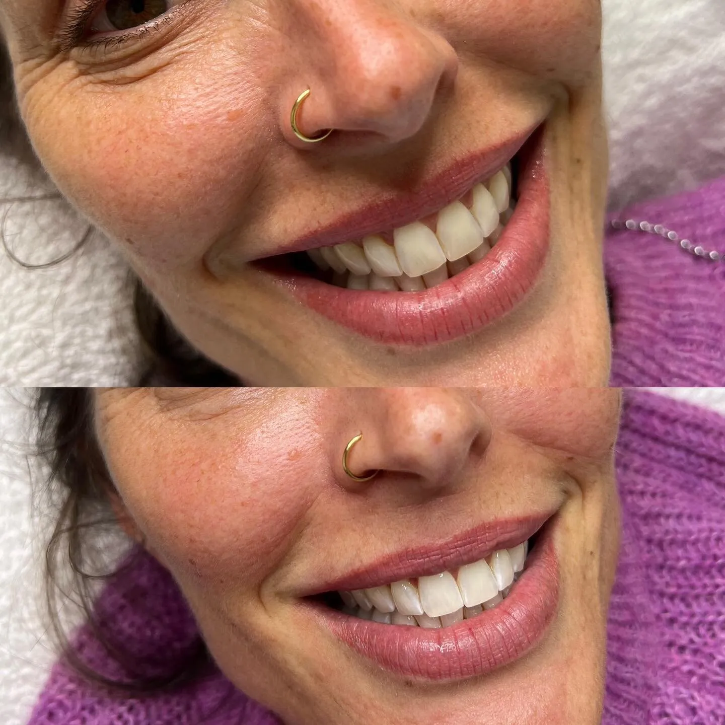 32028 teeth whitening marbella professional