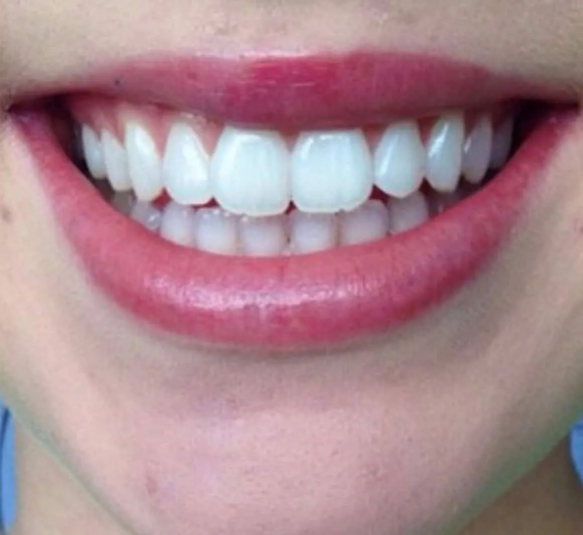32028 teeth whitening marbella results