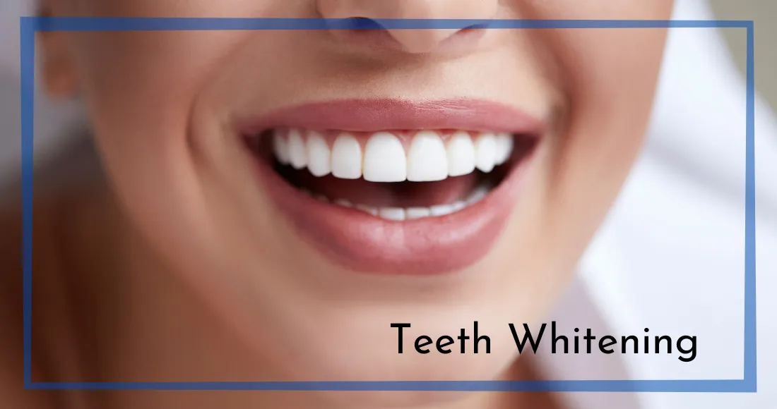 32030 teeth whitening shreveport la 1