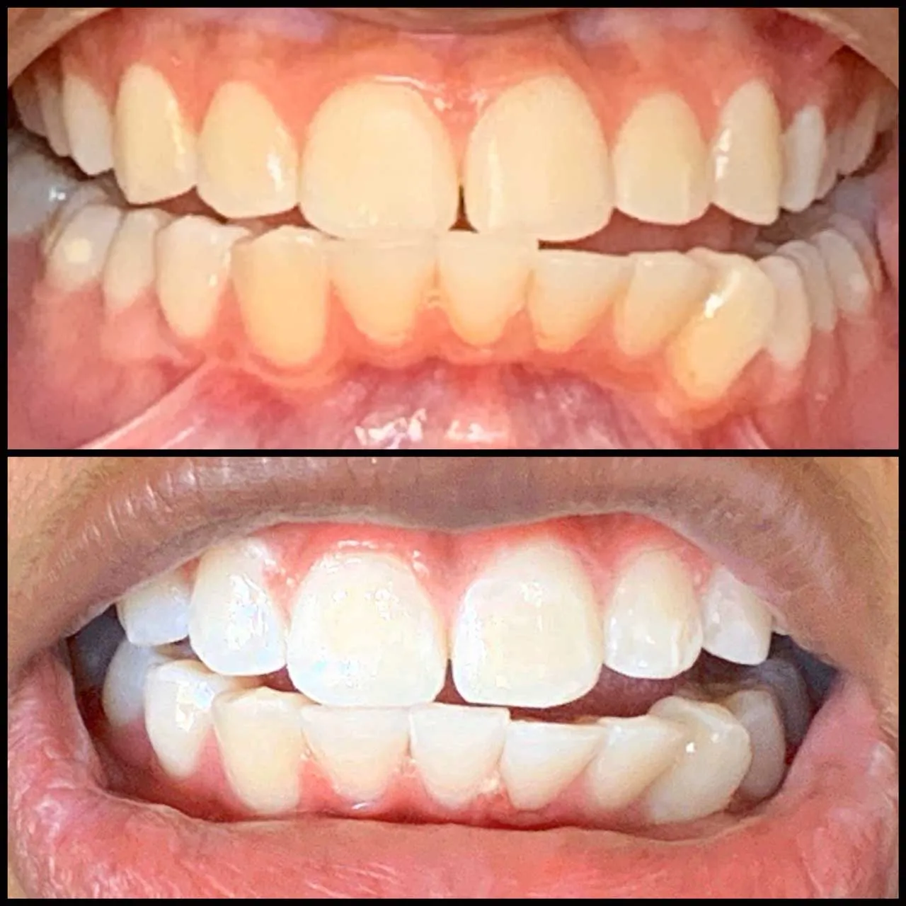 32030 teeth whitening shreveport la 3