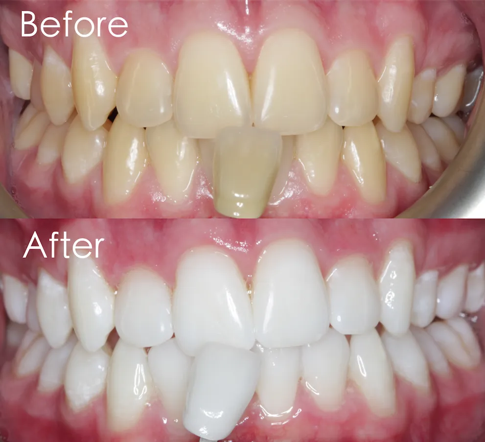 32032 laser teeth whitening benefits