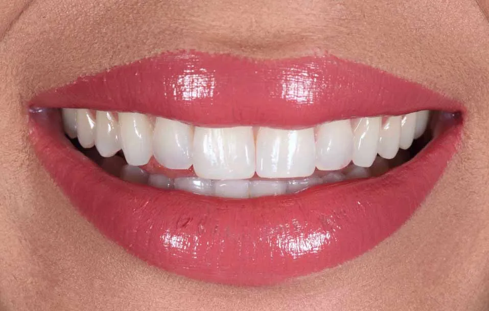 /img/32038-teeth-whitening-coventry-smile.webp