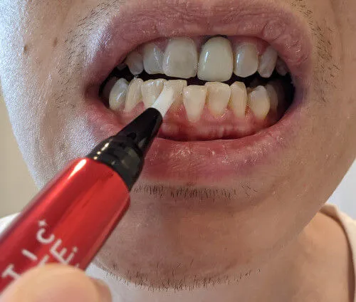 32041 gum irritation