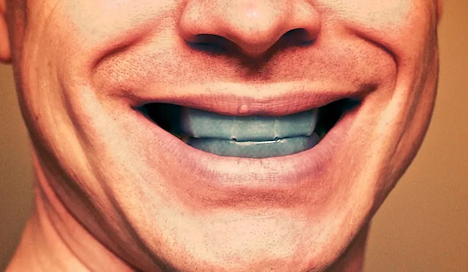 32041 professional teeth whitening