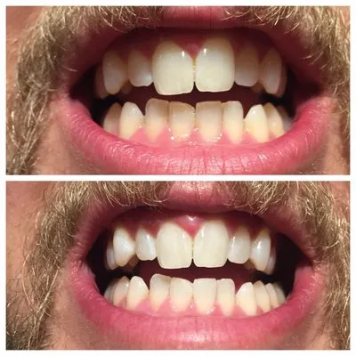 32043 zero glow teeth whitening video oral hygiene