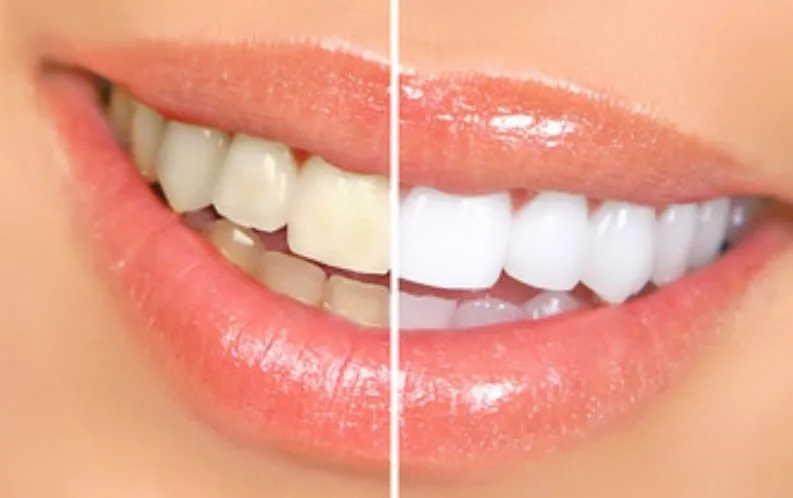 32043 zero glow teeth whitening video sensitive teeth