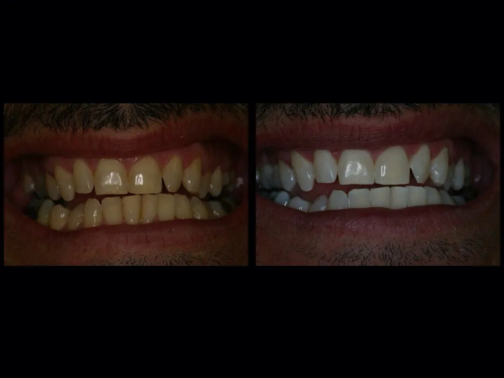 32050 dairy free yogurt after whitening