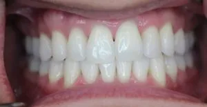 32050 zoom whitening diet importance