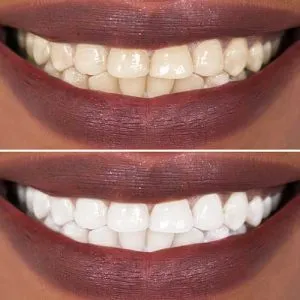 32051 teeth whitening gel application