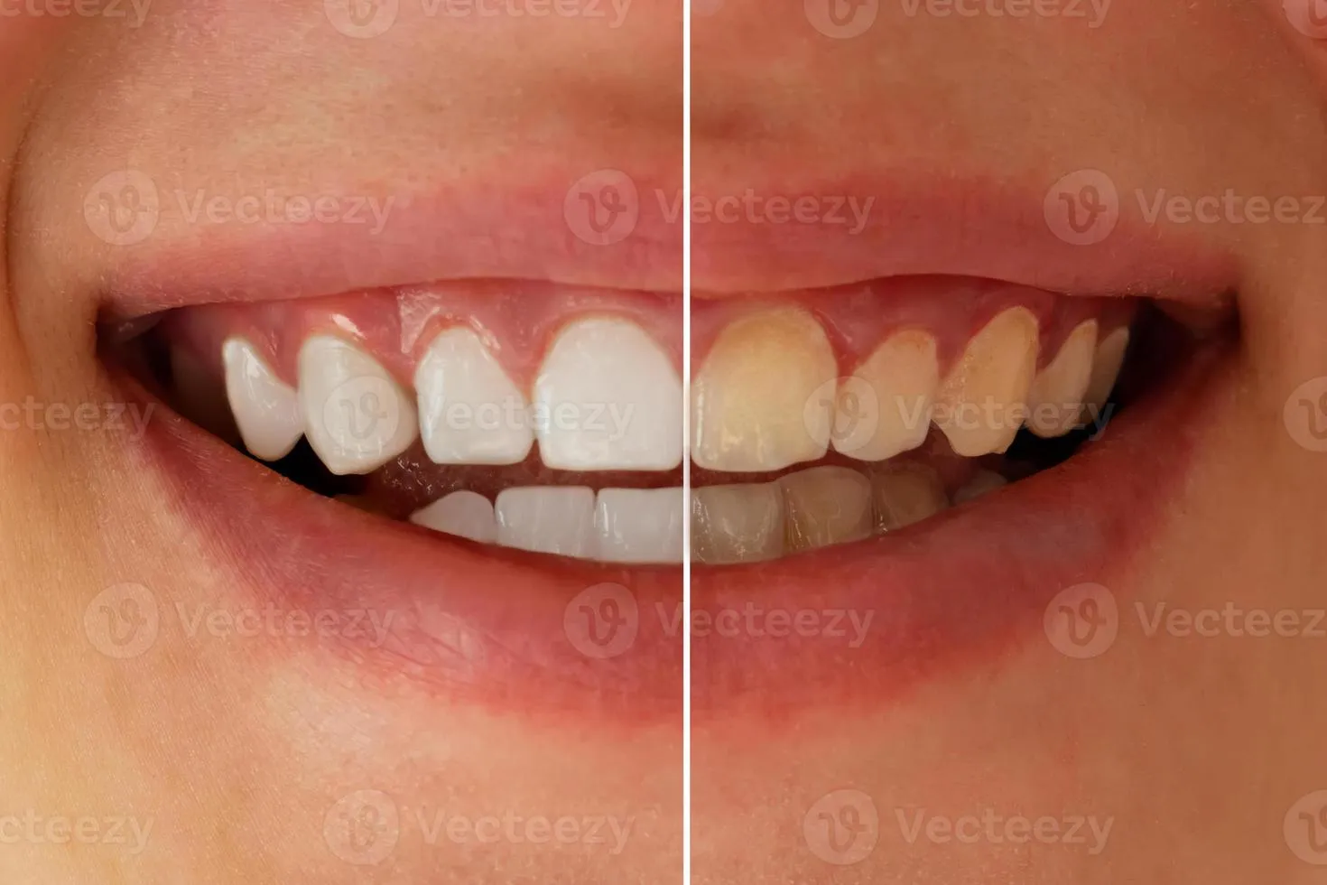 32051 teeth whitening gel before and after 2