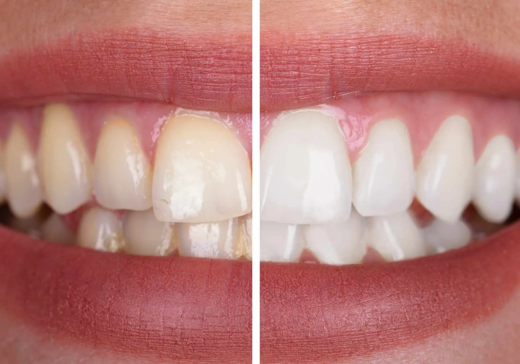 32051 teeth whitening gel post care