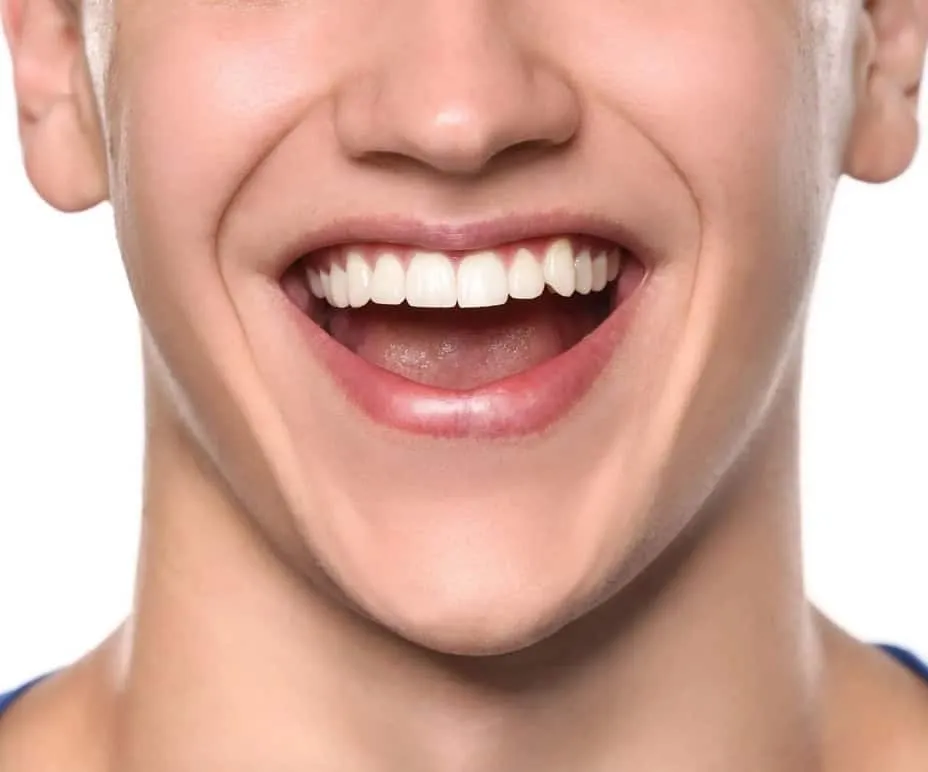 32053 at home teeth whitening kit