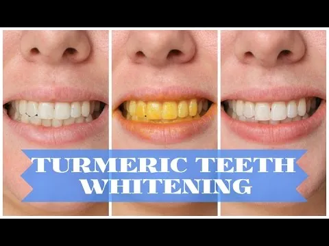 /img/32054-teeth-whitening-options.webp