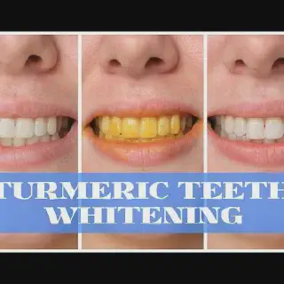 /img/32054-teeth-whitening-options.webp