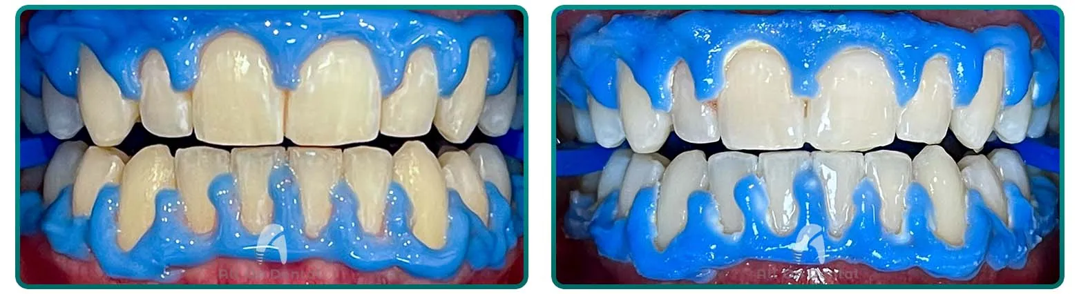 32055 over the counter teeth whitening