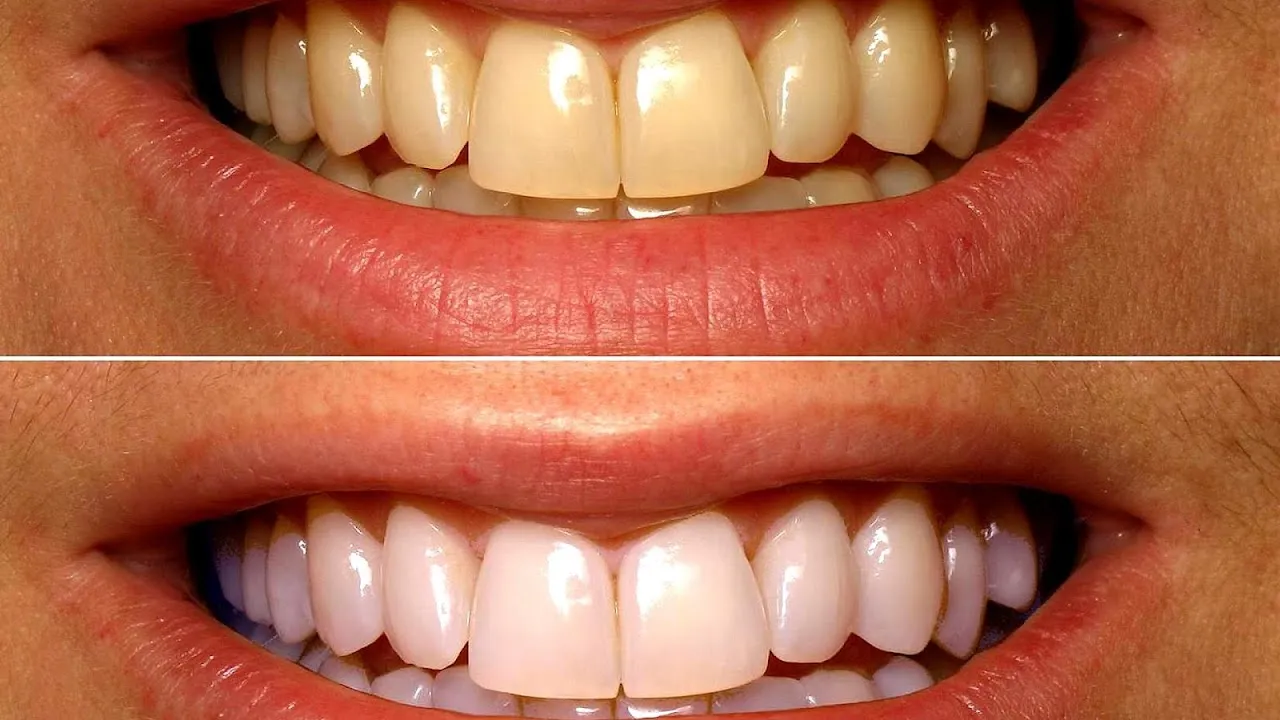 32061 at home teeth whitening