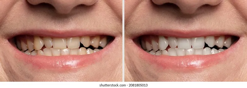 32061 teeth whitening smile