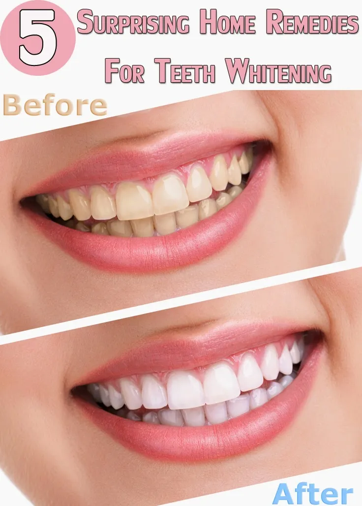32062 lemon juice teeth whitening