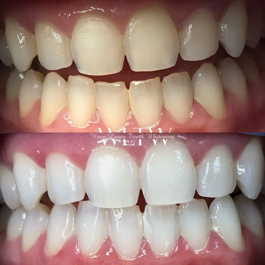 32063 teeth whitening san marcos ca image5