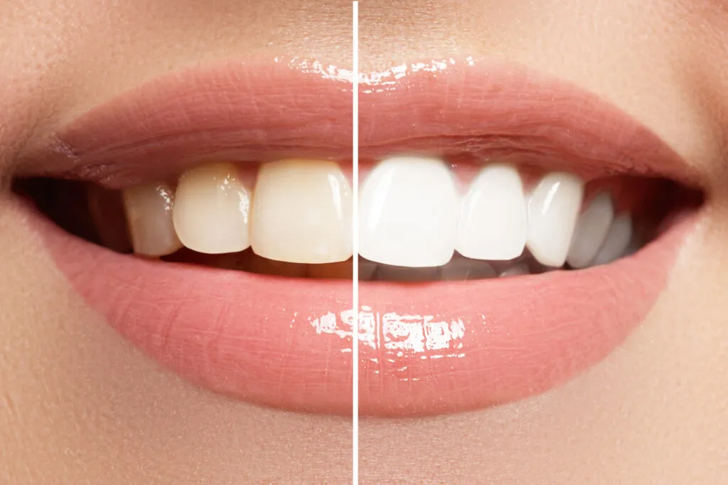 /img/32064-teeth-whitening-aftercare.webp