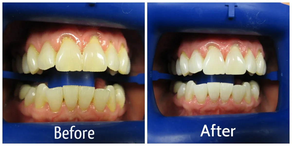 32064 zoom whitening results