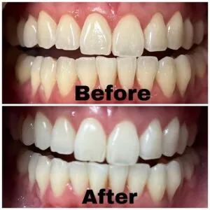 32070 teeth whitening before after