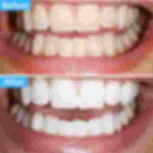 32080 polar night teeth whitening maintenance