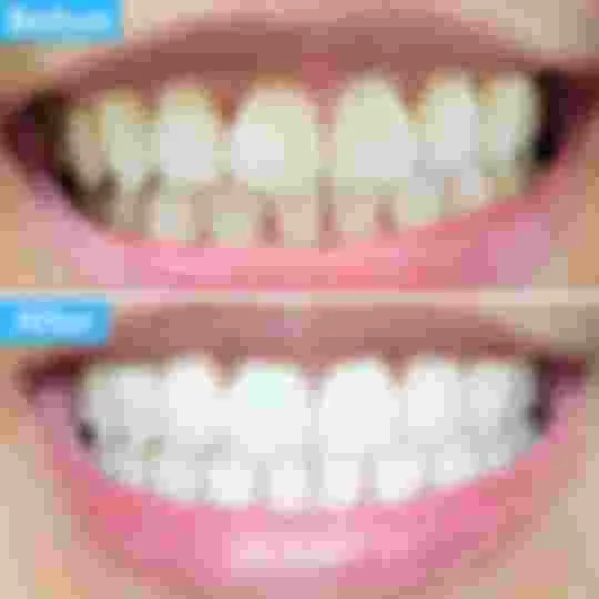 32080 teeth whitening oral hygiene