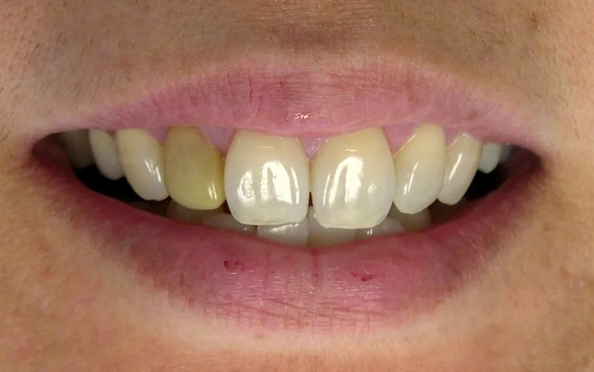 32081 teeth whitening consultation