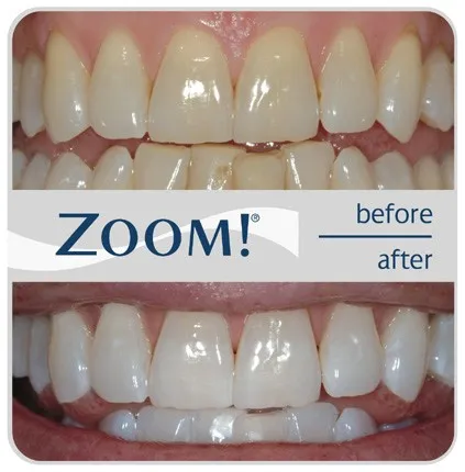 32081 teeth whitening process