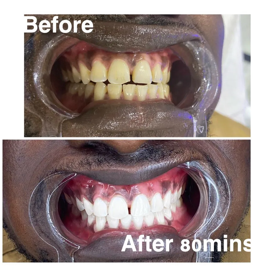 32087 teeth whitening spa image 4