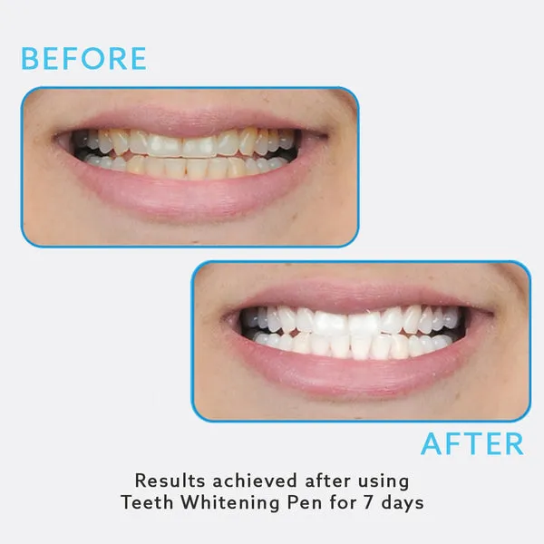 32090 radiance teeth whitening sensitivity