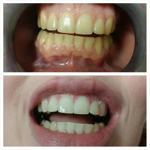 32095 beehive teeth whitening comparison