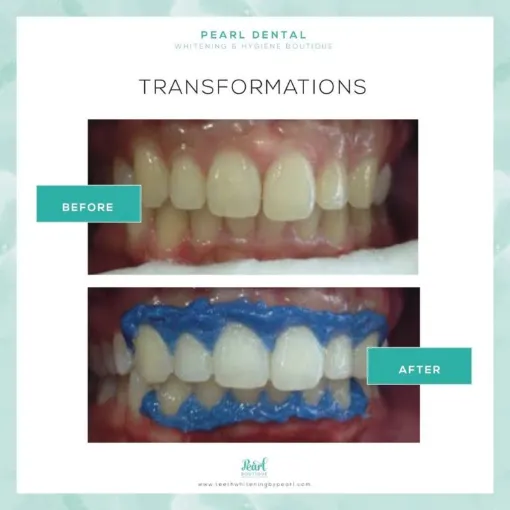 32097 teeth whitening vancouver wa 6