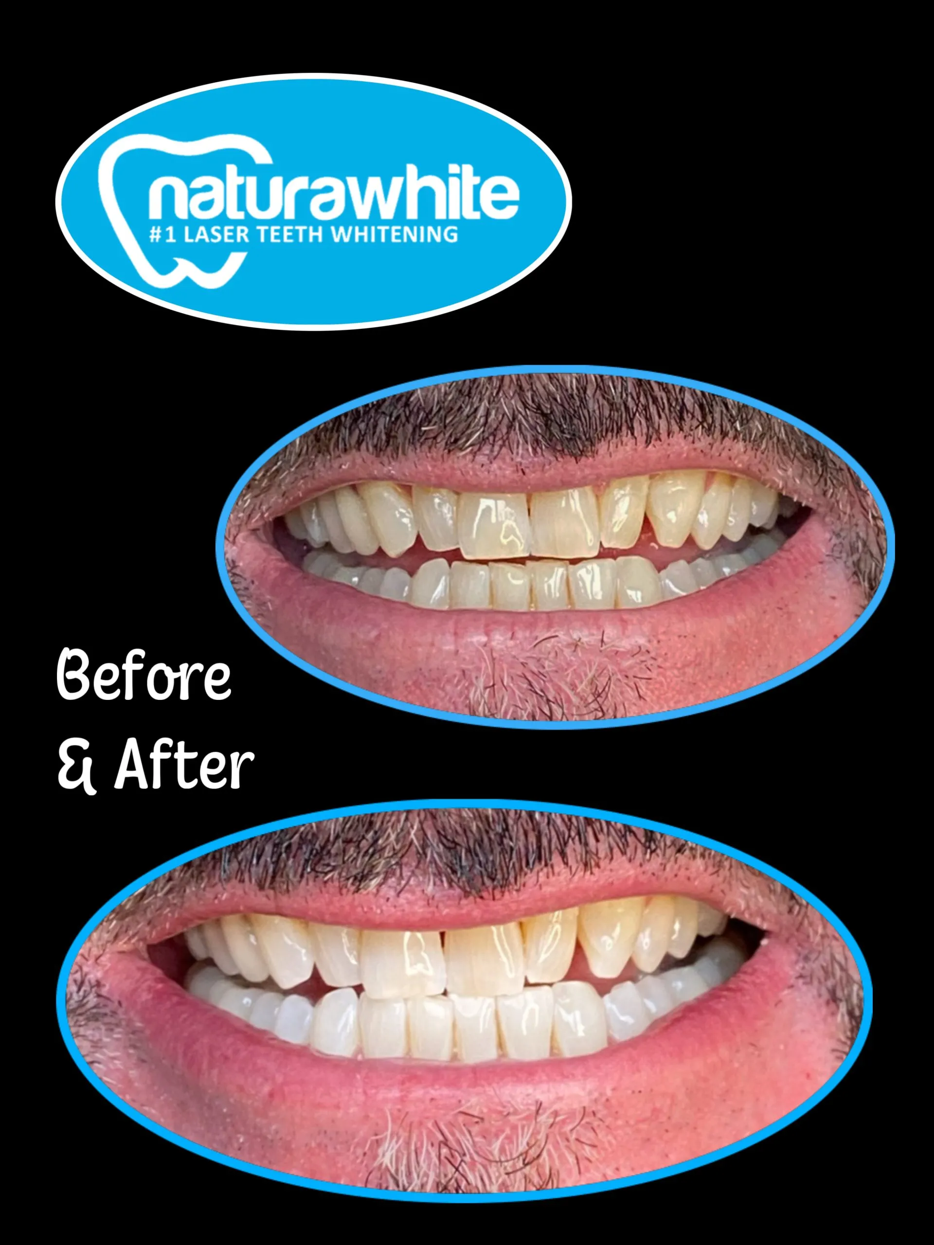 32098 teeth whitening before after