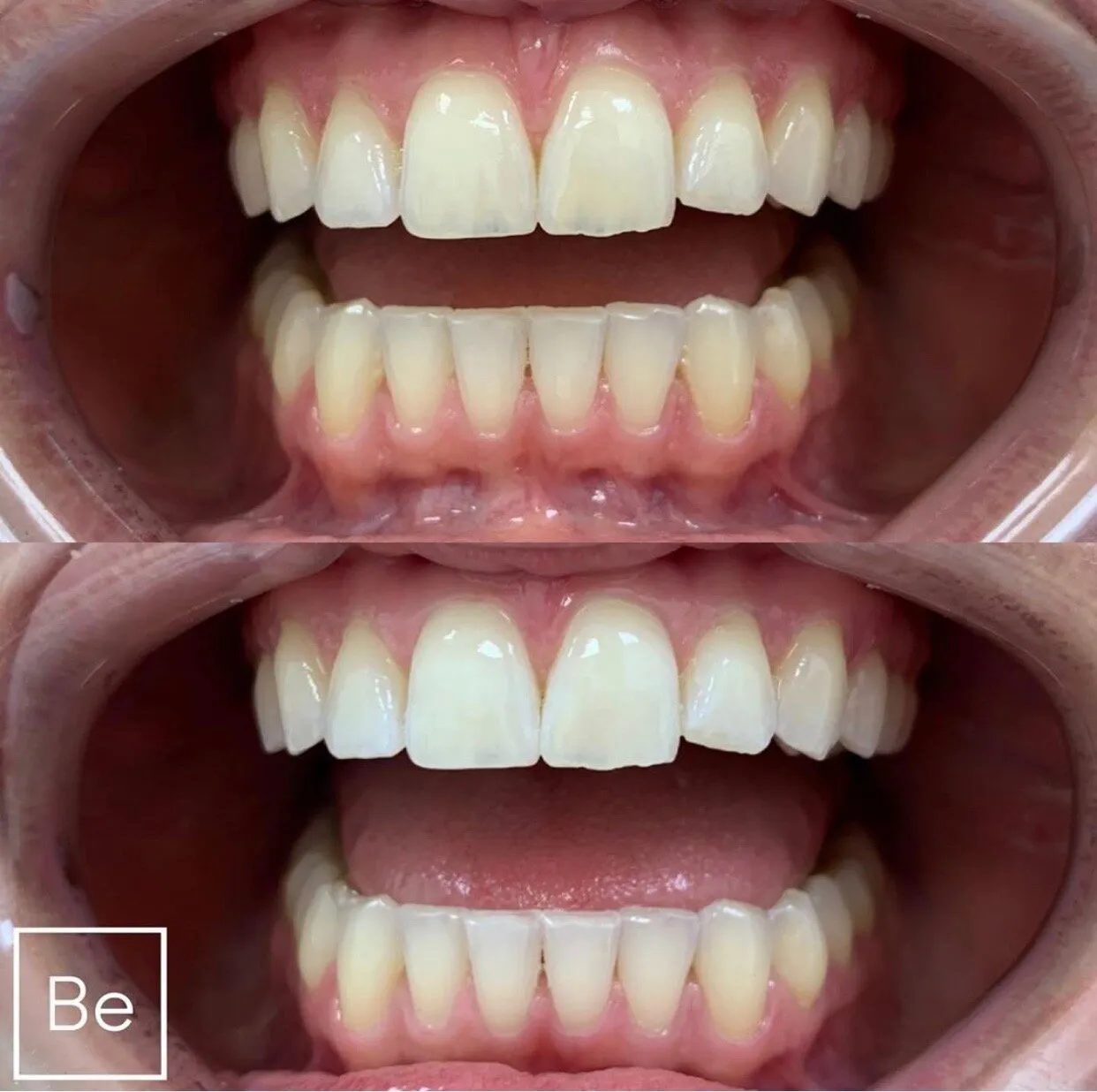 32102 take home whitening kits