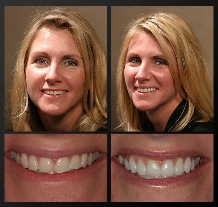 32102 teeth whitening rochester ny 1