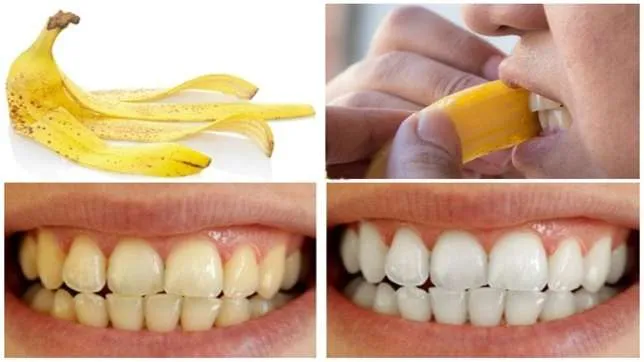 32104 teeth whitening results