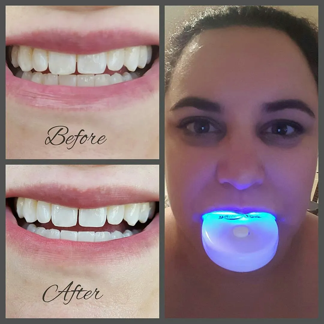 32105 teeth whitening kit main