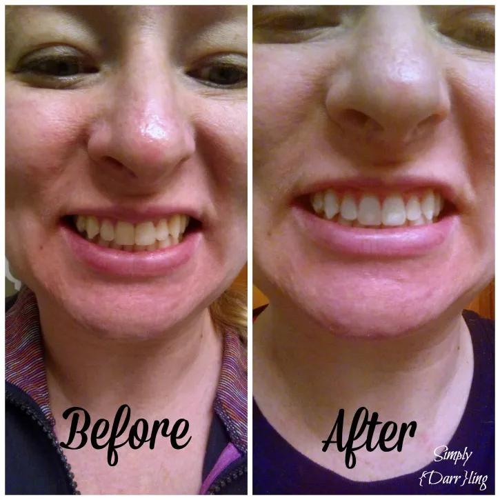 32107 teeth before after