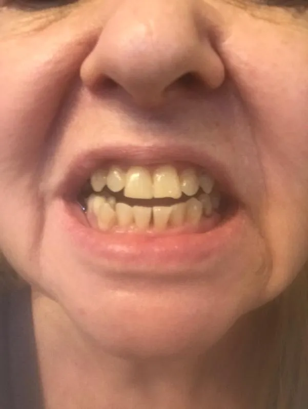 32107 tooth sensitivity tips