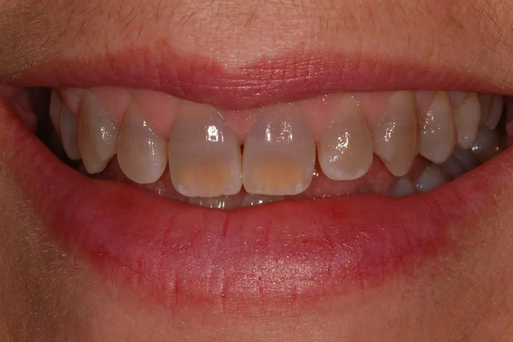 32109 kor whitening vs other methods