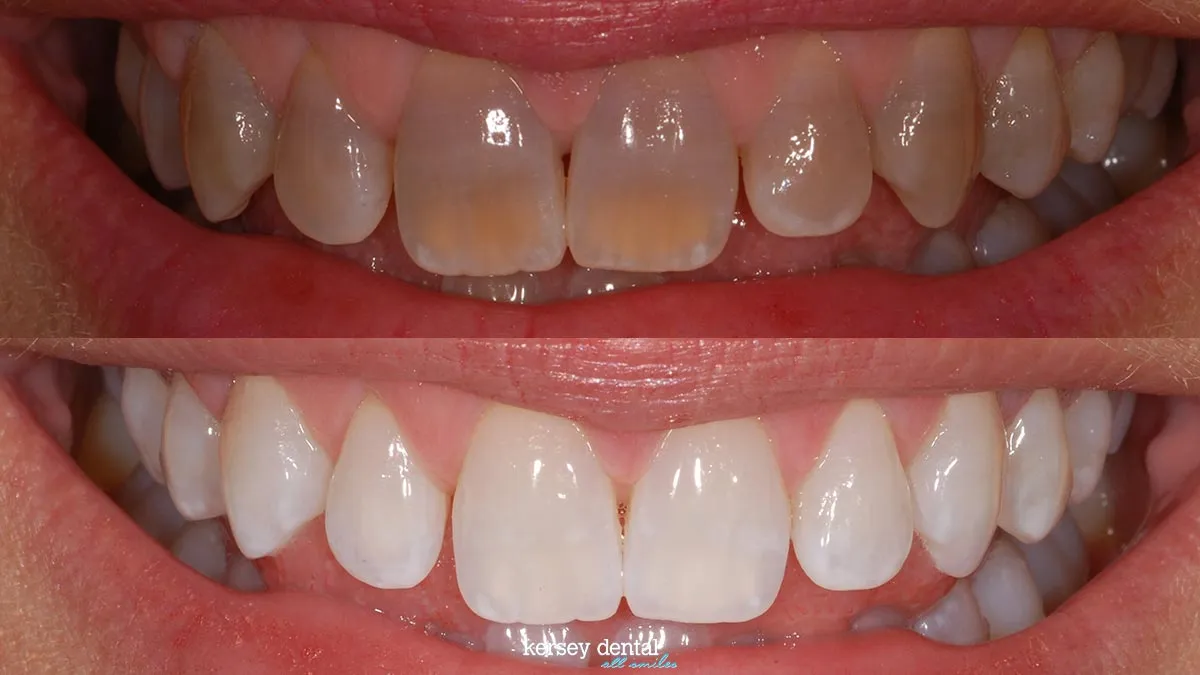 32109 tetracycline stained teeth