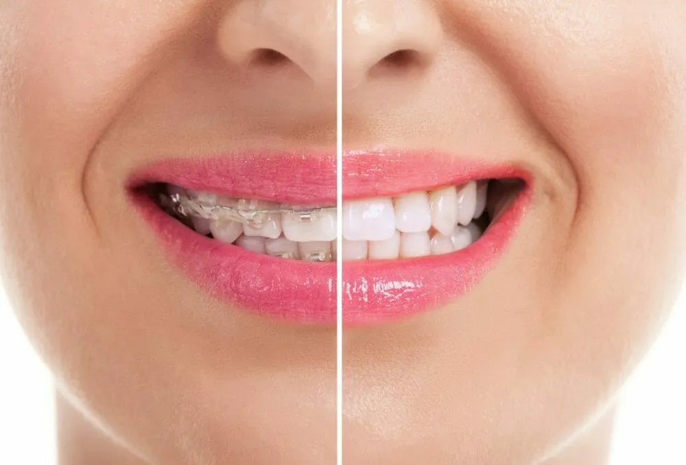 32110 teeth whitening after braces 3
