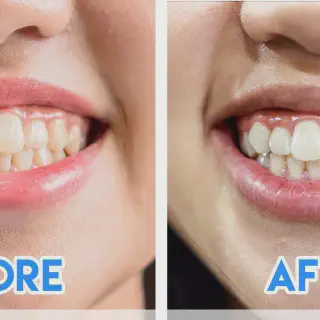 /img/32110-teeth-whitening-after-braces-7.webp