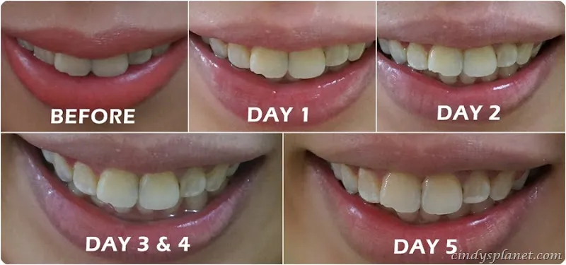 32111 opalescence vs alternatives