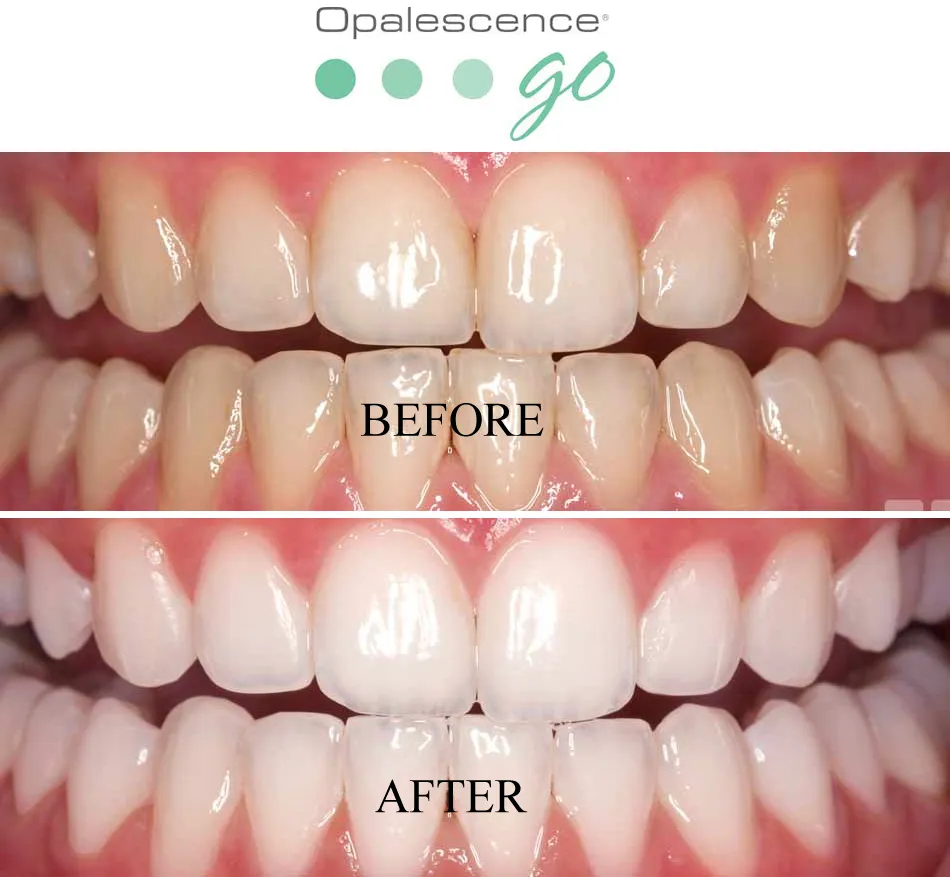 32111 teeth whitening maintenance