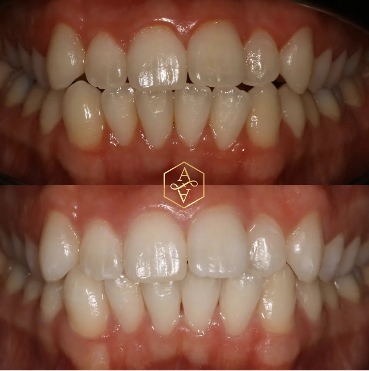 32119 gautier teeth whitening before after