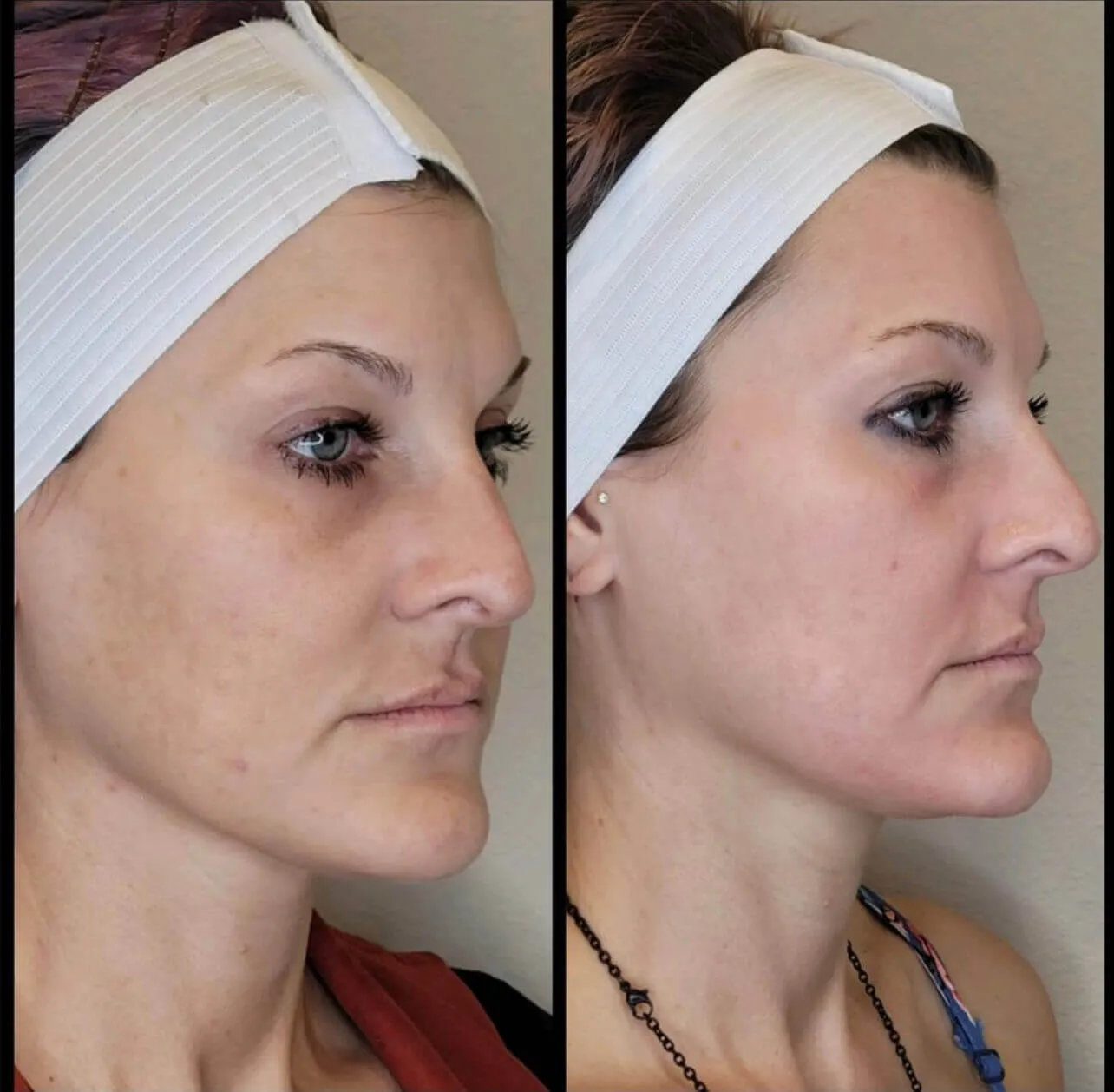 32120 fractional laser